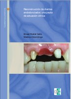 Reconstrucción de dientes endodonciados: Pautas de actuación clínica - Ernest Mallat Callís